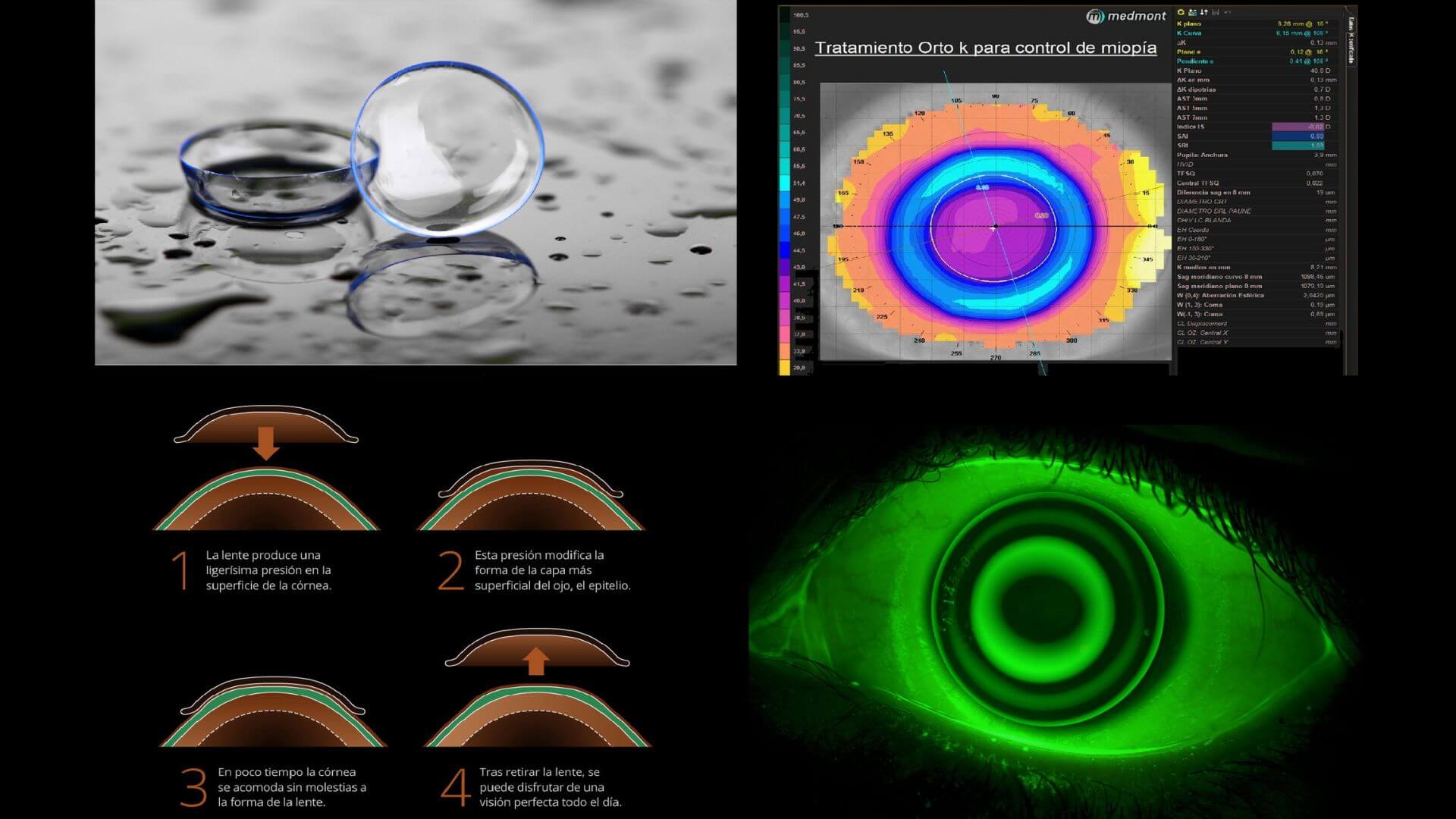 tratamiento lentillas orto k Piedras Blancas
